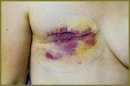 The Prognosis of the Course of Disseminated Breast Cancer Using Mathematical Model of the Balance of Proliferation and Cell Loss Factor