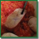 Multimodal Optical Coherence Tomography for Intraoperative Evaluation of Tumor Margins and Surgical Margins in Breast-Conserving Surgery