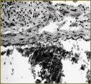 The Development of a New Way of a Combined Burning Injury Modeling