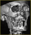 Favourable Outcome of Foreign Body Removal from Left Orbital Cavity and Cribriform Bone