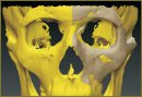 Planning Technique in Maxillofacial Plasty