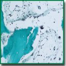 Material-Associated Bone Resorption
