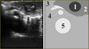The Role of Intraoperative Ultrasonography in Pancreatic Solid Tumor Staging
