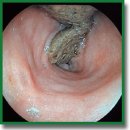 The Model of Crohn’s Disease on Large Laboratory Animals — Pigs