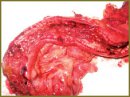Rare Clinical Mask of the Ileum Crohn’s Disease