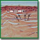 Morphological Changes in Keratoconus: Interpretation of Corneal Confocal Microscopy Findings