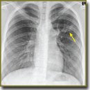 Capabilities of Tomosynthesis in Diagnosing Chest Diseases and Injuries