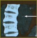 A Case of Successful Treatment of Spasticity in the Patient with Vertebrospinal Trauma