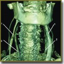 The Role of the Compression of Great Cervical Vessels by Thyroid Nodules in Eye Hydrodynamics Change