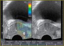 A Case of Effective Diagnosis and Treatment of Colon Cancer with Extension to Prostate