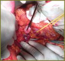 Superior Mesenteric Vein Isolation Technique in Proximal  Pancreas Resection