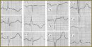 ​A Case of Cerebrocardiac Syndrome