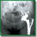 Application of a Fork Plate for Greater Trochanter Osteosynthesis in Total Hip Arthroplasty