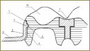 A New Clasp to Fix Partial Dentures