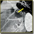 Liver Transplantation for Unresectable Hepatic Alveolar Echinococcosis