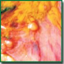 Laser Video Fluorescence Diagnosis of Stomach Diseases