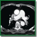 Endovascular Mechanical Thromboembolus Fragmentation in the Treatment of Critical Pulmonary Thromboembolism in Patients with Acute Hemorrhagic Stroke