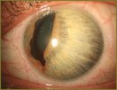 The Opportunities of Ultrasound Biomicroscopy in Diagnosis and Monitoring of Iridocorneal Endothelial Syndrome