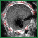 Poly-D,L-Lactide-co-Glycolide and Sodium Enoxaparin Composition — an Advanced Coating for Vascular Stents: Biocompatibility and Efficiency Assessment of Stent-Grafts in an Experiment on Large Animals