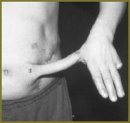 Osteocutaneous Repair of Fingers Using Blood Supplied Grafts