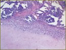 The Effect of Low Intensity Laser Radiation on Specific Inflammation Activity in Tuberculous Patients and Long-Term Results of their Treatment