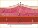 The Possibilities and Advantages of Sutureless Plasty of Abdominal Wall Using Different Synthetic Meshes in Experimental Study