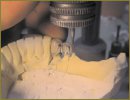 The Technique of Orthopedic Alignment of Free-End Edentulous Space in Partial Tooth Loss