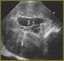 Diagnostic Ultrasound of Diffuse-Nodular Pleural Mesotheliomas — Echosemiotics, Growth Characteristics, and Scanning Techniques