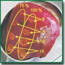 An UHF Thermal Coagulator for Achieving Hemostasis During Operations on Parenchymatous Organs
