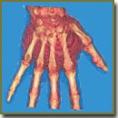 A Standardized Protocol for Cone-Beam Computed Tomography of the Hand and Wrist in Rheumatoid Arthritis