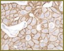 The Prognostic Significance of Receptor Status in Patients with Early Breast Cancer