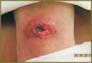 New Cryosurgical Instruments in Treatment of Tumors and Purulent Diseases of Skin and Subcutaneous Fat