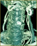 Compression of Great Cervical Vessels in Nodular Goiter as Indication for Thyroidectomy