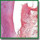 Regenerative Cell Technologies for Gingival Recession Treatment