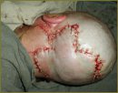 Expander Dermatension is a New Method of Surgical Replacement of Skin Defects
