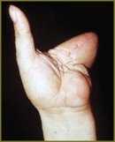 Key Principles of Staged Combined Reconstruction of Fingers