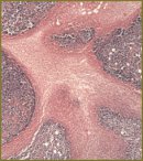 The Study of Combined Effect of Microwave Energy and Gold Nanoparticles on Tumor in Experiment