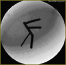 Method of the Coronary Bed Spatial Reconstruction —  a Method of Preoperative Preparation of Patients  with Ischemic Heart Disease