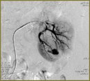 Laparoscopic Nephrectomy and Resection in the Therapy of Renal Tumors