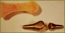 Individual Replacement of Bones and Joints the Foot in the Treatment of Degenerative Dystrophic Diseases