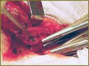 The Possibilities of Use Intraoperative Diathermic Ablation of Benign Thyroid Nodular Masses