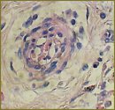Surgical Prevention Technique of the Primary Bronchus Stump Insufficiency Using a Fibrin-collagenic Plate