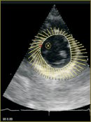 VVI Technique Possibilities in the Assessment of the Indices of Left Ventricular Systolic Function and All Its Segments