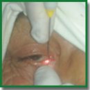Modification of Endoscopic Dacryocystorhinostomy in Chronic Dacryocystitis