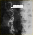 Experience of the Esophagoenterostomy Insufficiency Successful Treatment after a Gastrectomy with the ELLA Esophageal Stent
