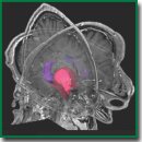 Hippocampal Functional Connectivity and Cognitive Stability in Parasellar Meningiomas (Studied by the “Virtually Implanted Electrode” Method)
