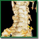 Diagnostic Imaging in Patients with Spinal Injury: an Optimized Procedure Based on Novel Technologies