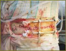 A Case of the Severe Gunshot Penetrating Multiple Wound of the Abdomen Complicated by a Local and Generalized Infectious Process