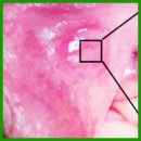 Multimodal Optical Coherence Tomography: Imaging of Blood and Lymphatic Vessels of the Vulva
