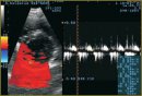 Peculiarities of the Left Ventricle Segmental Diastolic Dysfunction  and Structural and Geometrical Reconstruction in Children  with a Diabetes Mellitus of the 1st Type